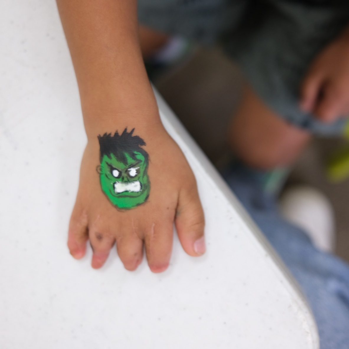 Congenital Hand Differences