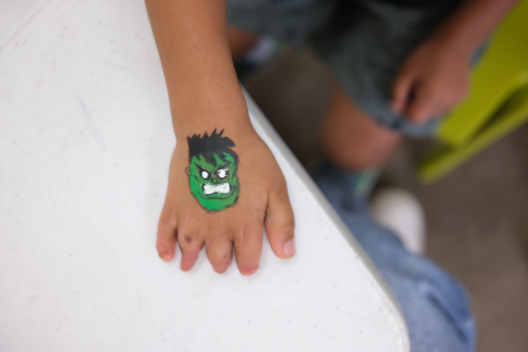 Congenital Hand Differences