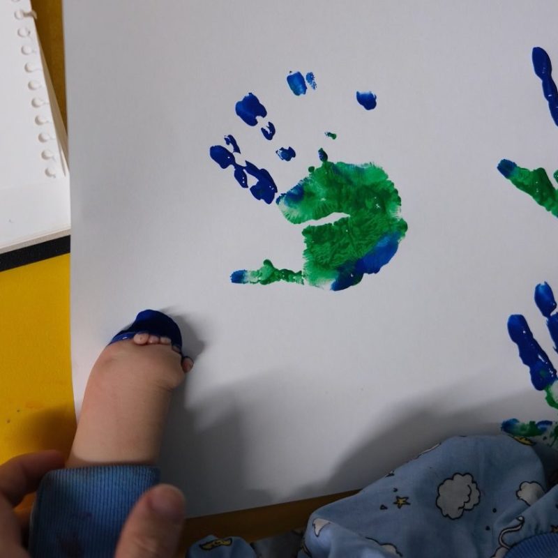 Navigating congenital hand differences with paediatric hand therapy/occupational therapy